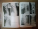 PATOLOGIE VERTEBROMEDULARA CERVICALA de C. ARSENI , GH. PANOZA , Bucuresti 1981